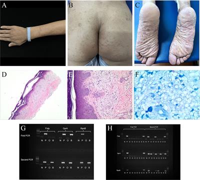 Fever of unknown origin, blood and cerebrospinal fluid involvement: a leprosy case report